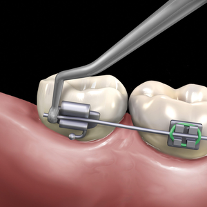 Distal Cinch Back Slim Line (Hu-Friedy)