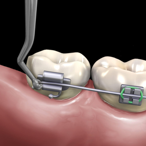 Distal Cinch Back Slim Line (Hu-Friedy)